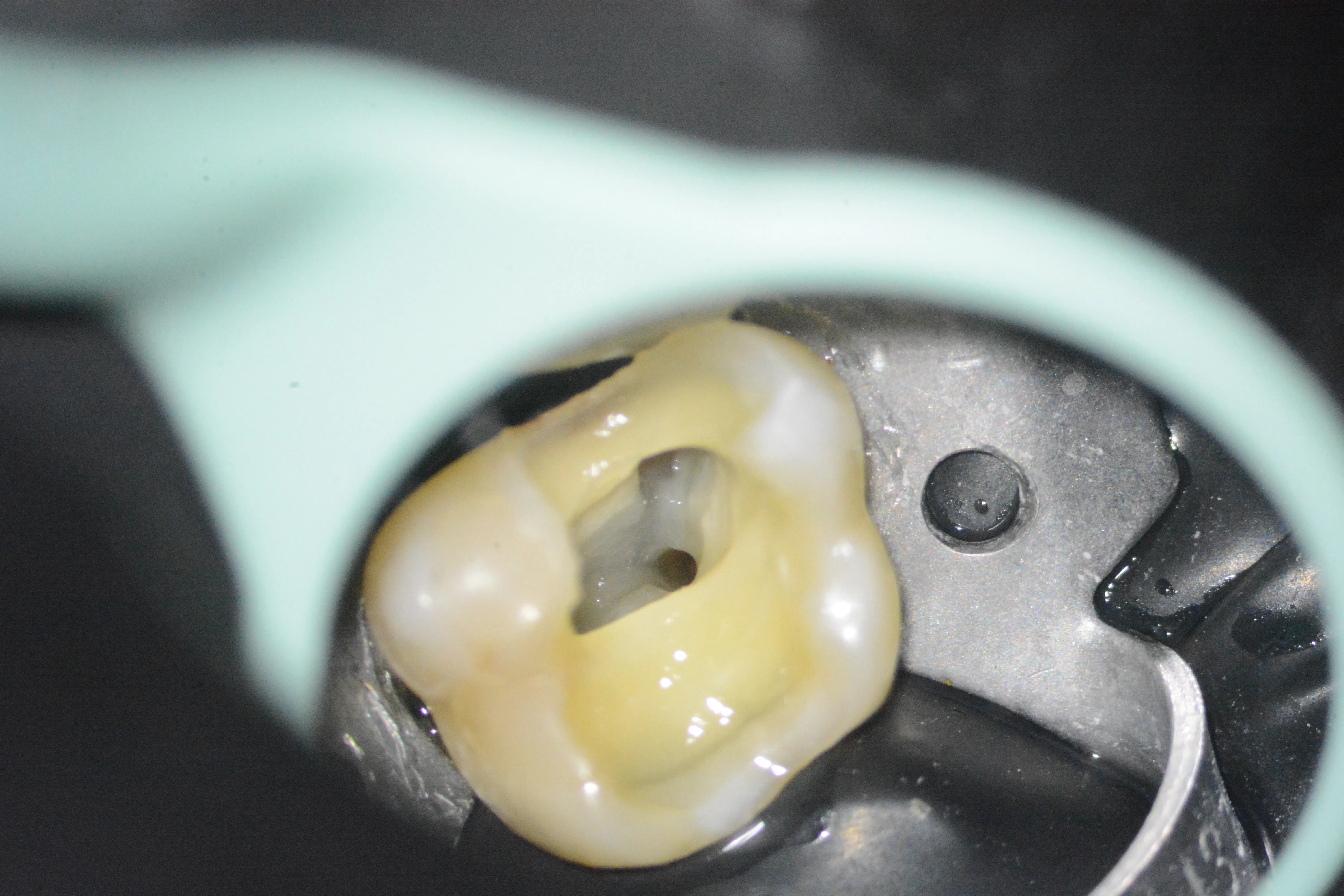 7 - Aspectul canalului distal după finalizarea tratamentului mecanico-antiseptic