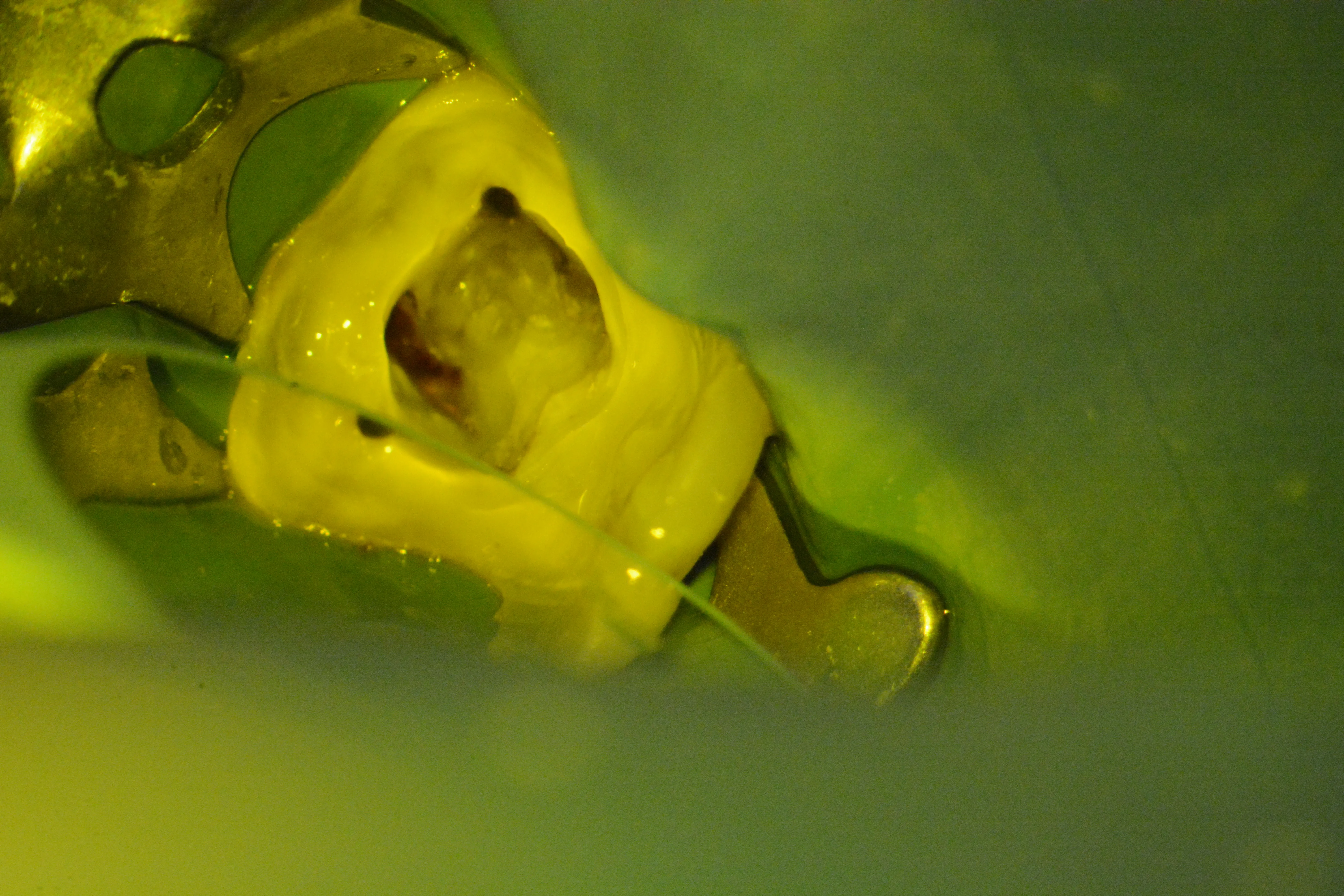 7 – Sigilarea foliei de digă mezial