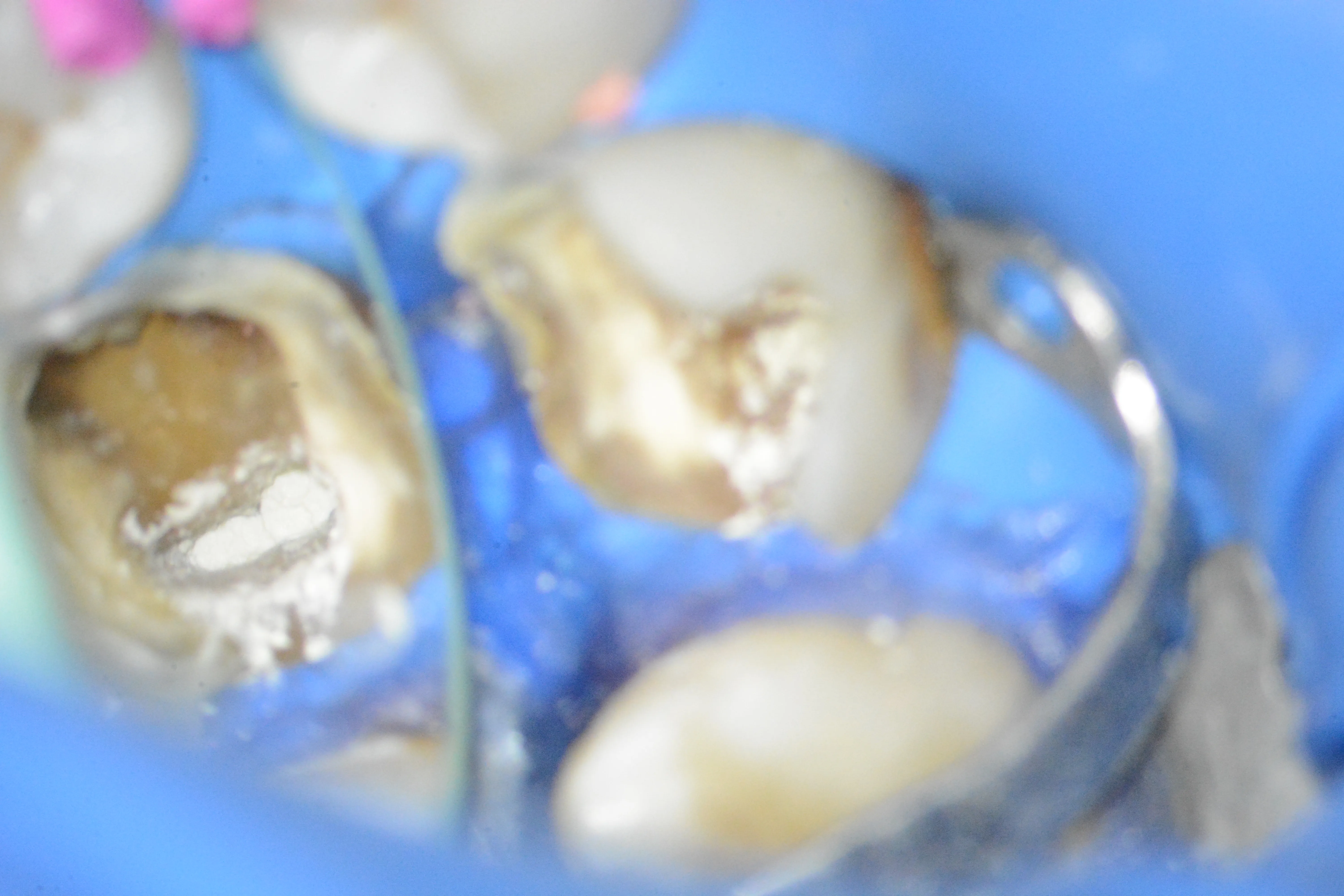 8 – Sigilarea apexului rădăcinii distale cu MTA