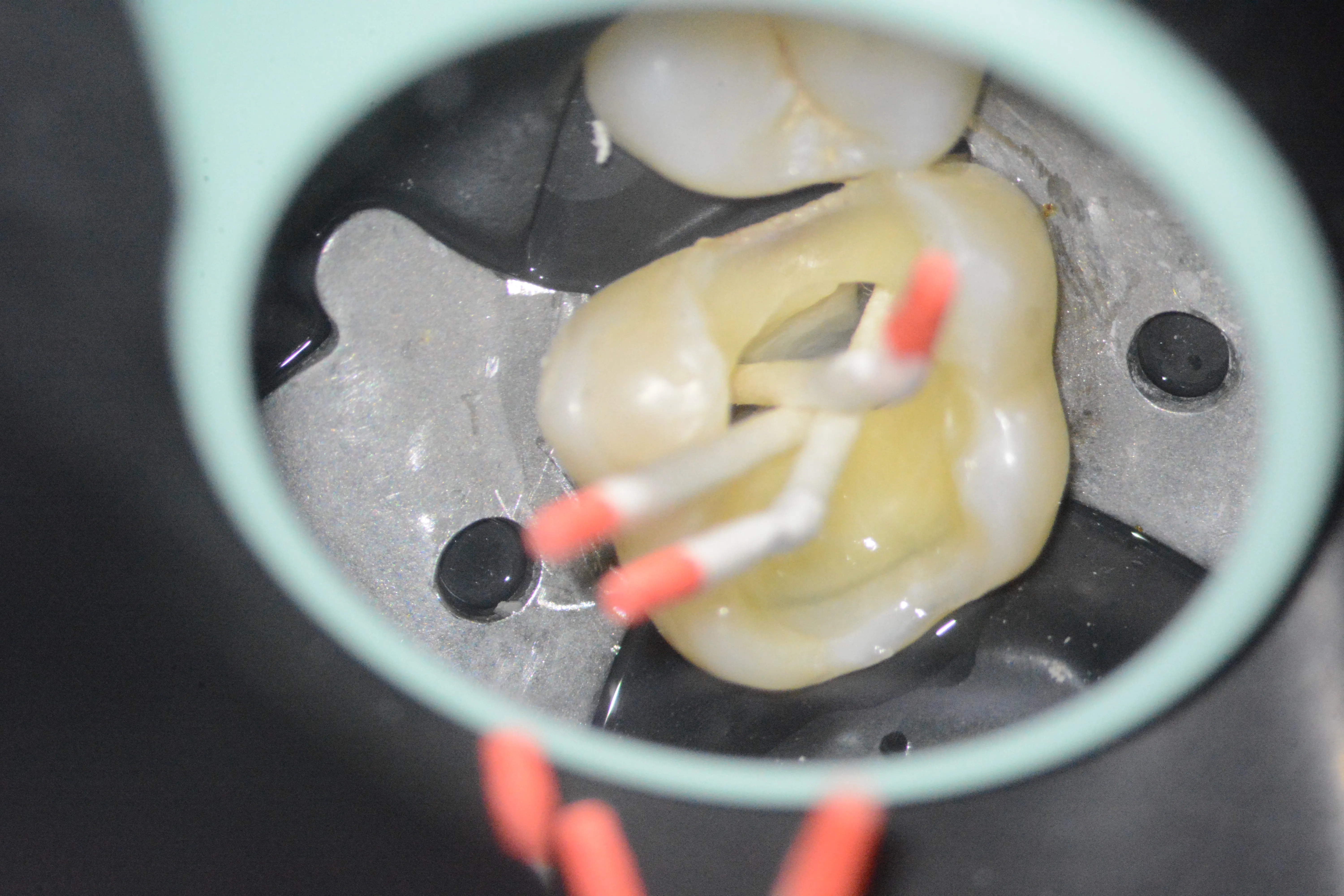 8 – Uscarea canalelor radiculare