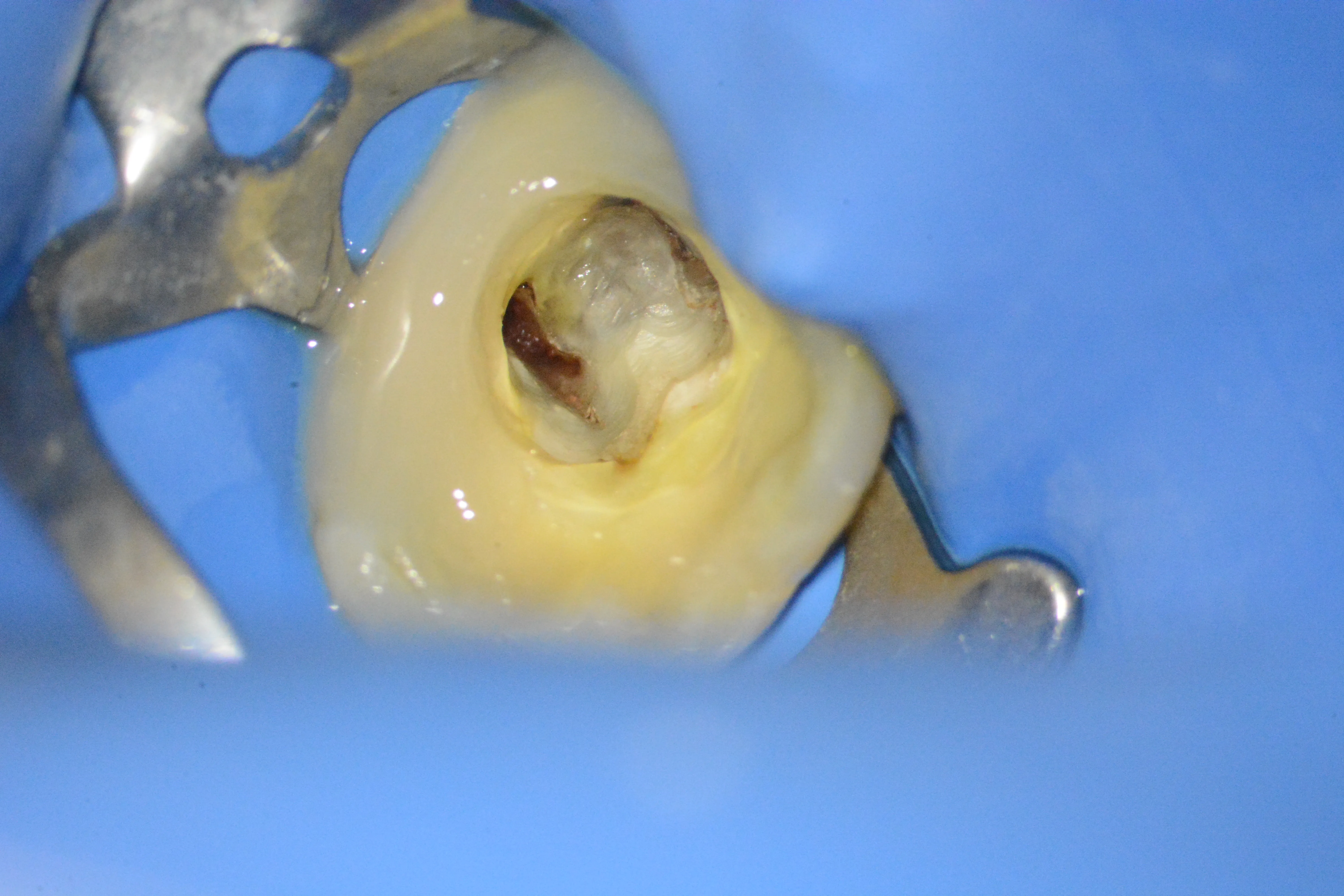 8 – Reconstrucție preendodontică