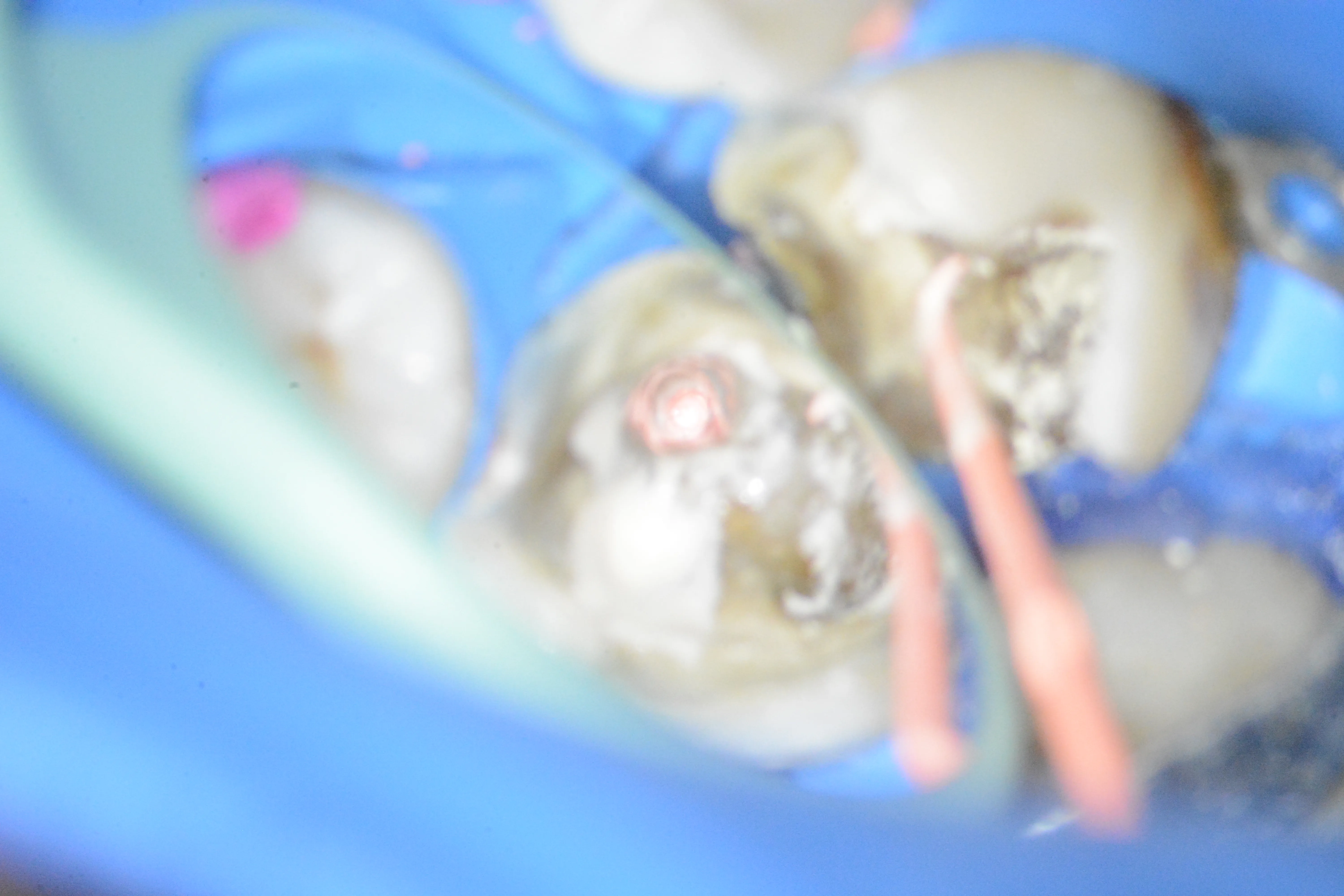 9 – Obturarea canalelor meziale cu sealer bioceramic și gutapercă