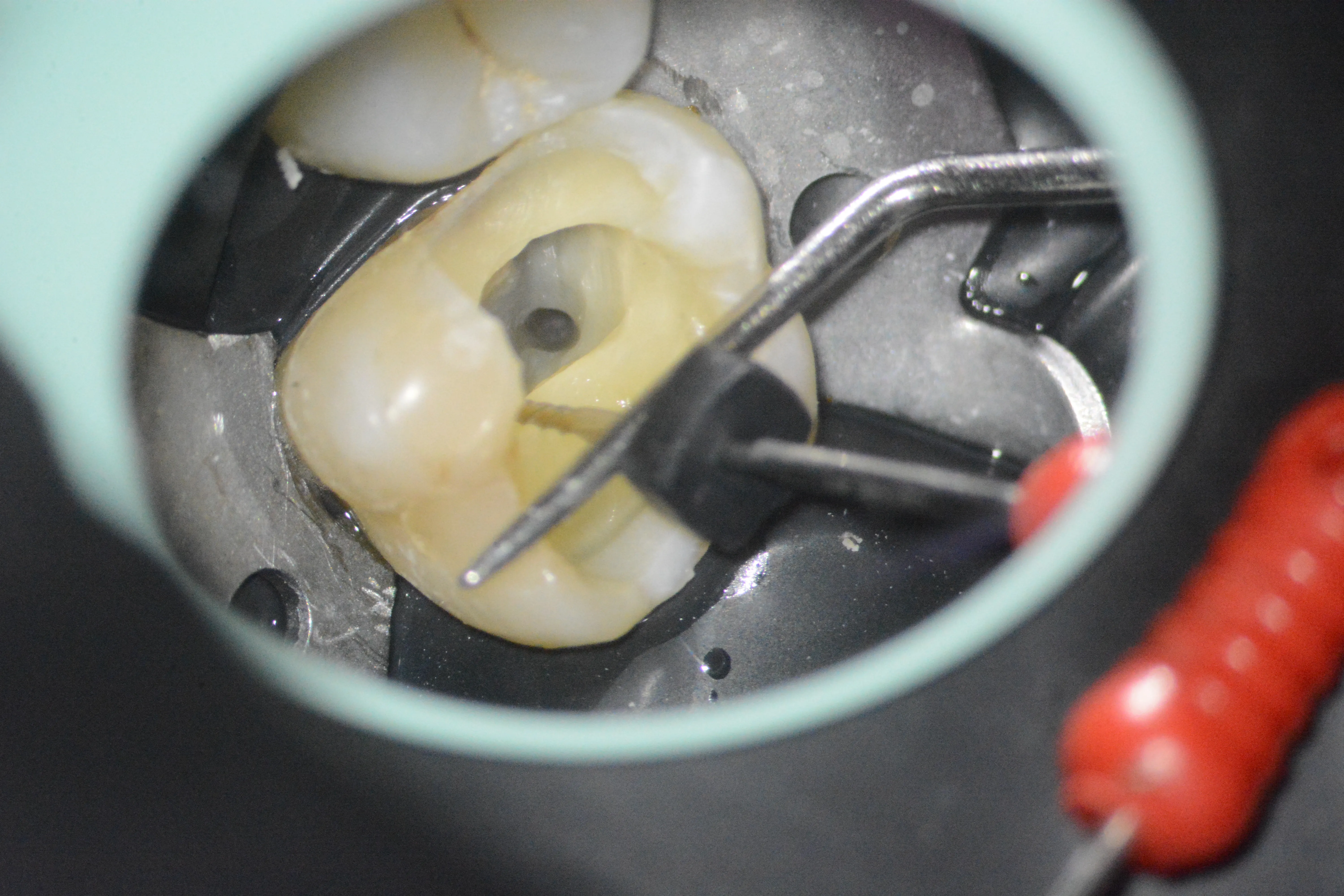 9 – Măsurarea canalelor radiculare