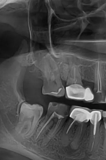 A - Radiografie inițială - secțiune OPT: obturație coronară cu carie secundară, hiperemie pulpară