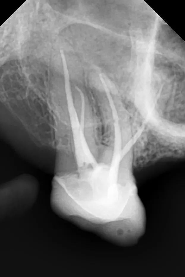 B - Radiografie de control imediat după finalizarea tratamentului: rădăcină suplimentară, reconstrucție coronară, incidență mezială