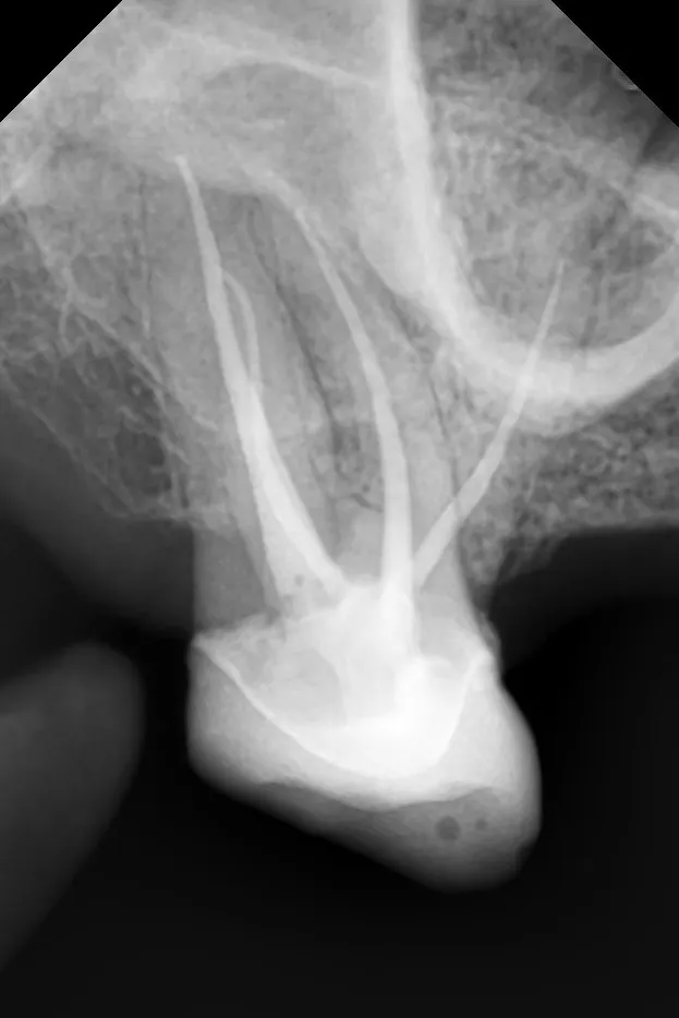 C - Radiografie de control imediat după finalizarea tratamentului: rădăcină suplimentară, reconstrucție coronară, Iincidență distală