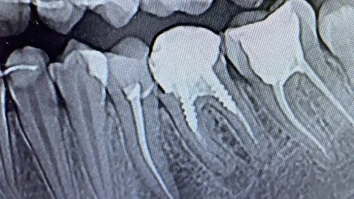 Retratament endodontic îndepărtare pivoți metalici Cluj-Napoca