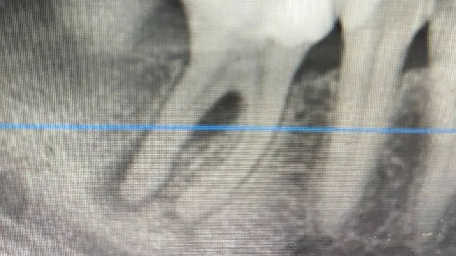 Tratament endodontic reparație perforație iatrogenă Cluj-Napoca