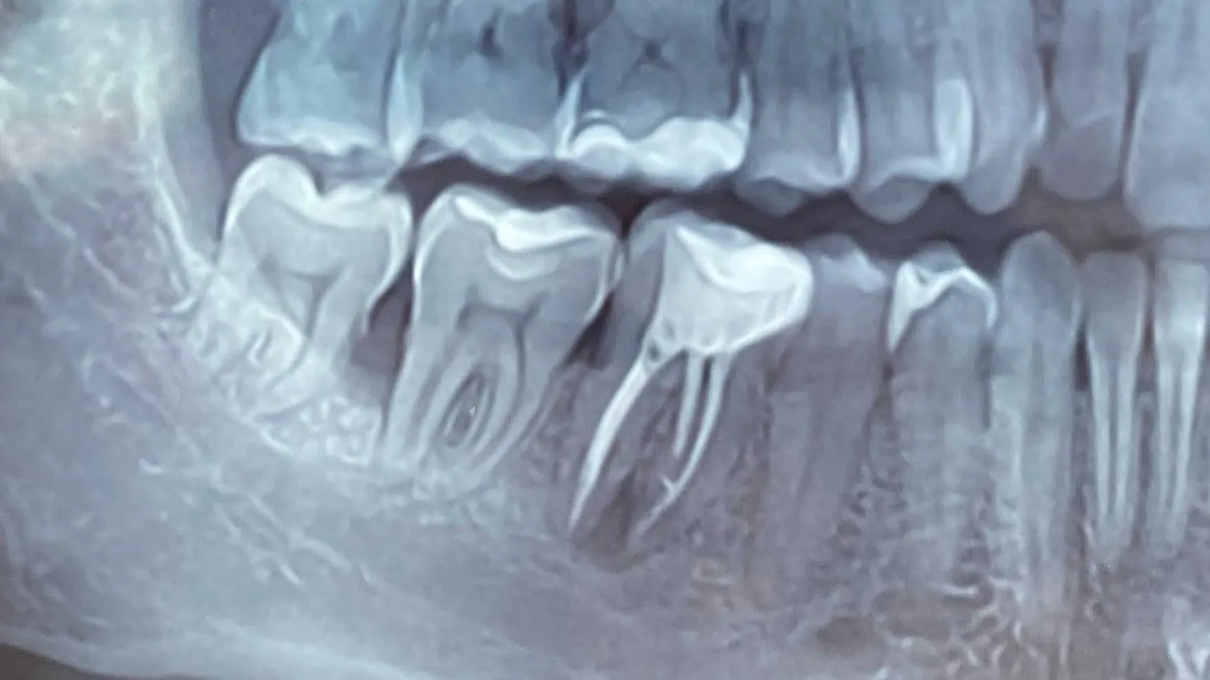 Retratament endodontic molar inferior Cluj-Napoca - endodont