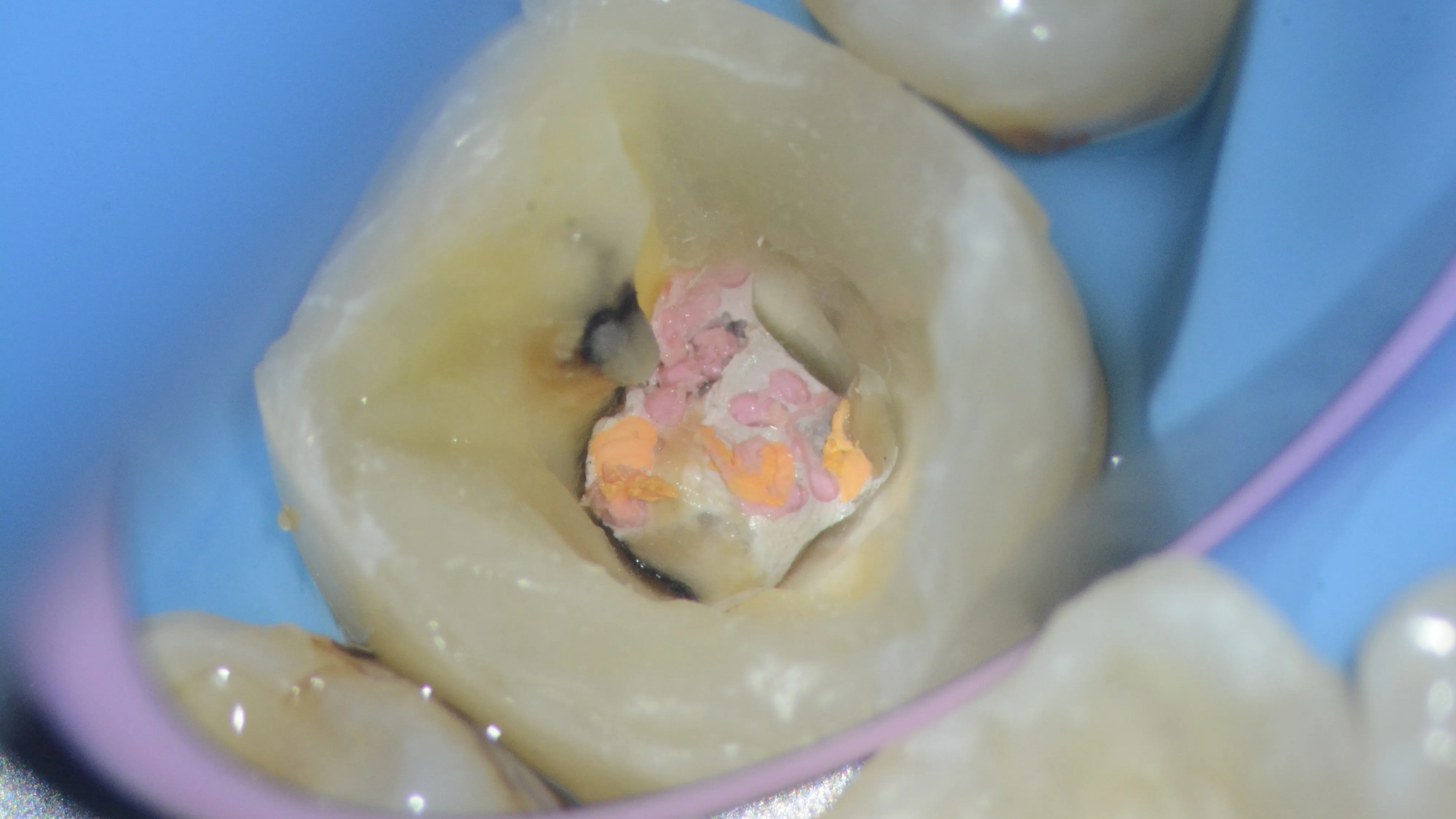 Retratament endodontic molar inferior Cluj-Napoca - carie recidivă