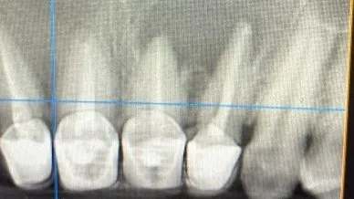 Retratament endodontic incisivi superiori chist maxilar Cluj-Napoca