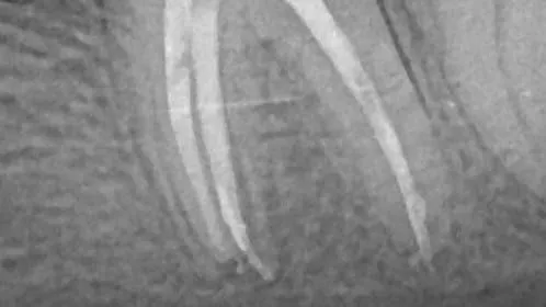 Retratament endodontic molar inferior instrument fracturat Cluj-Napoca