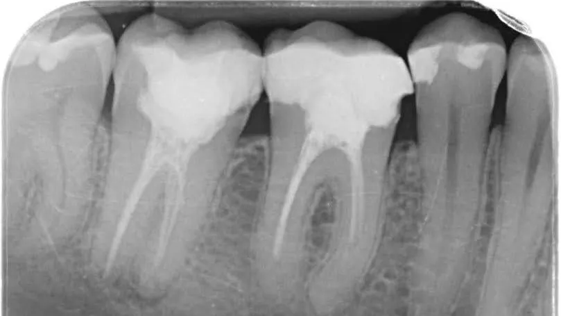 Retratamente endodontice molari inferiori Cluj-Napoca - caz complex