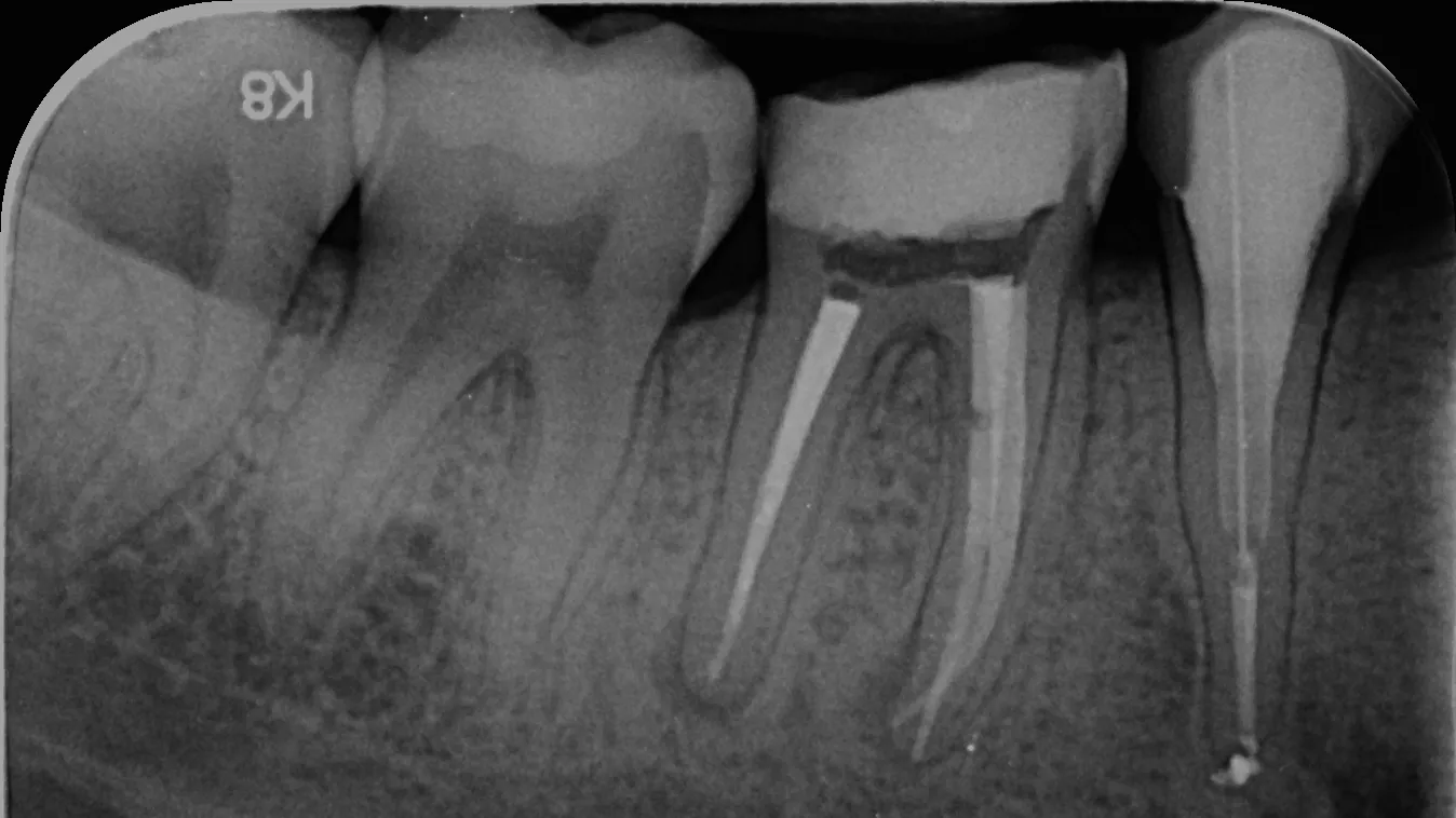 Retratament endodontic molar inferior Cluj-Napoca - endodont specialist